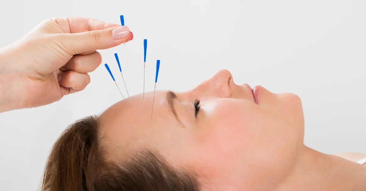 How long do acupuncture results last?