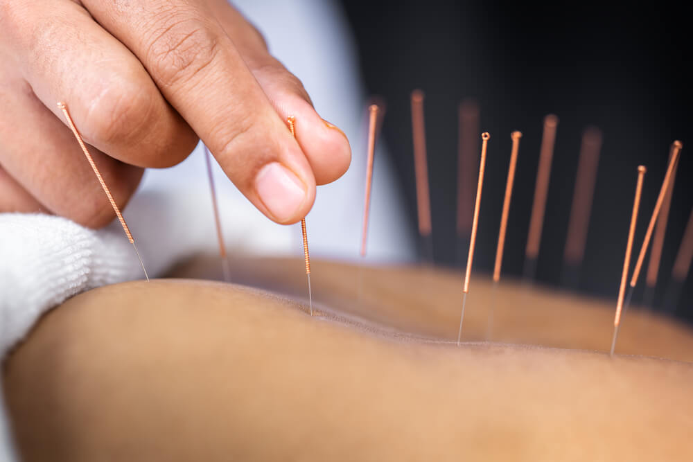 What is acupuncture Good For?