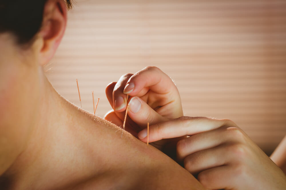 What do you wear during acupuncture?